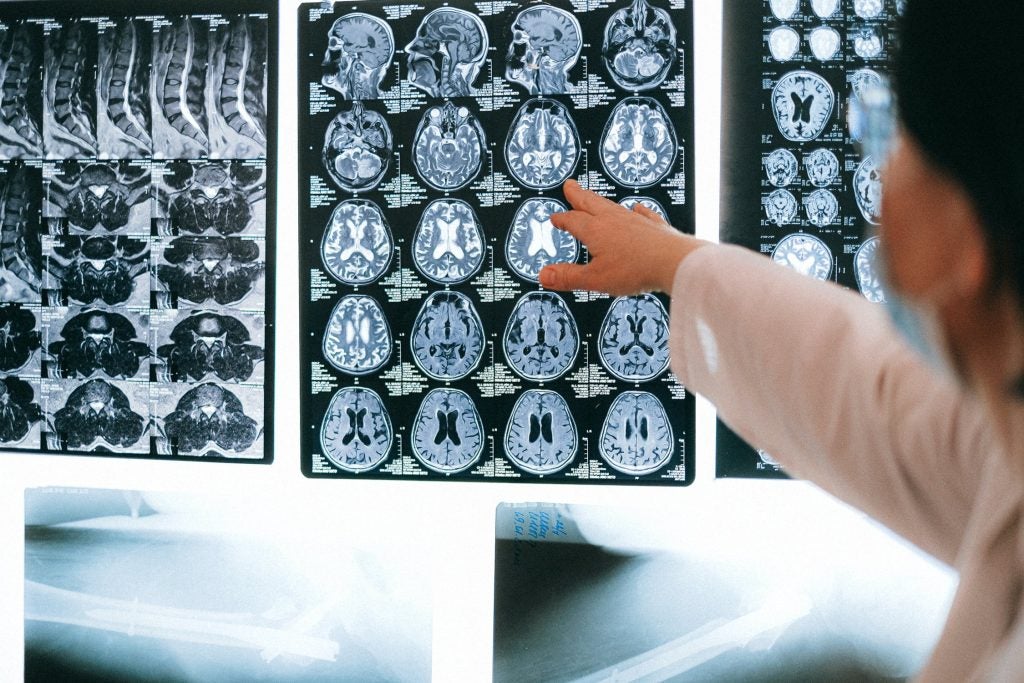 Doctor pointing to brain scans