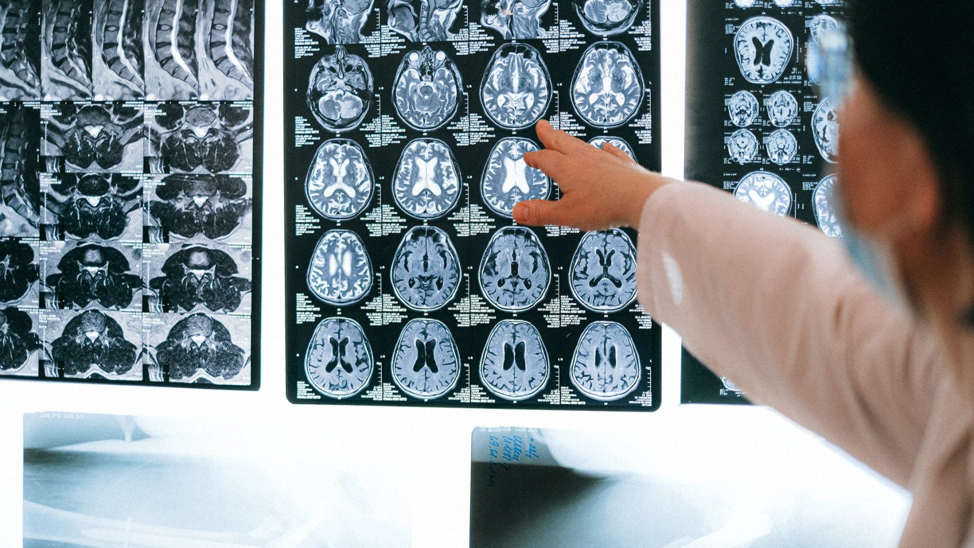 Doctor pointing to brain scans